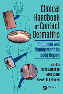 Download Clinical Handbook of Contact Dermatitis: Diagnosis and Management by Body Region - Robin Lewallen | PDF